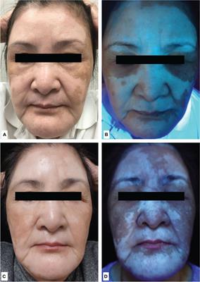 Frontiers | Anti-IL-17A Antibody-associated De Novo Vitiligo: Case ...